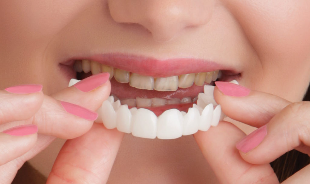 Snap-On-Smile-Application-hi-res-A-1024x607-1