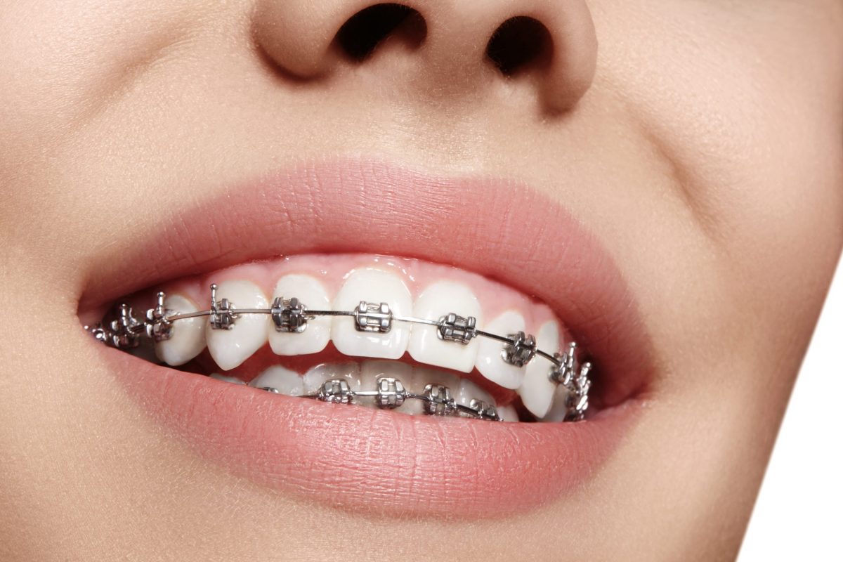 تقويم الاسنان, ابتسامة المشاهير, هووليود سمايل, تبييض الاسنان, تنظيف الاسنان, علاج الاسنان, افضل اخصائي تقويم الاسنان في ابوظبي, اجمل ابتسامة في ابوظبي