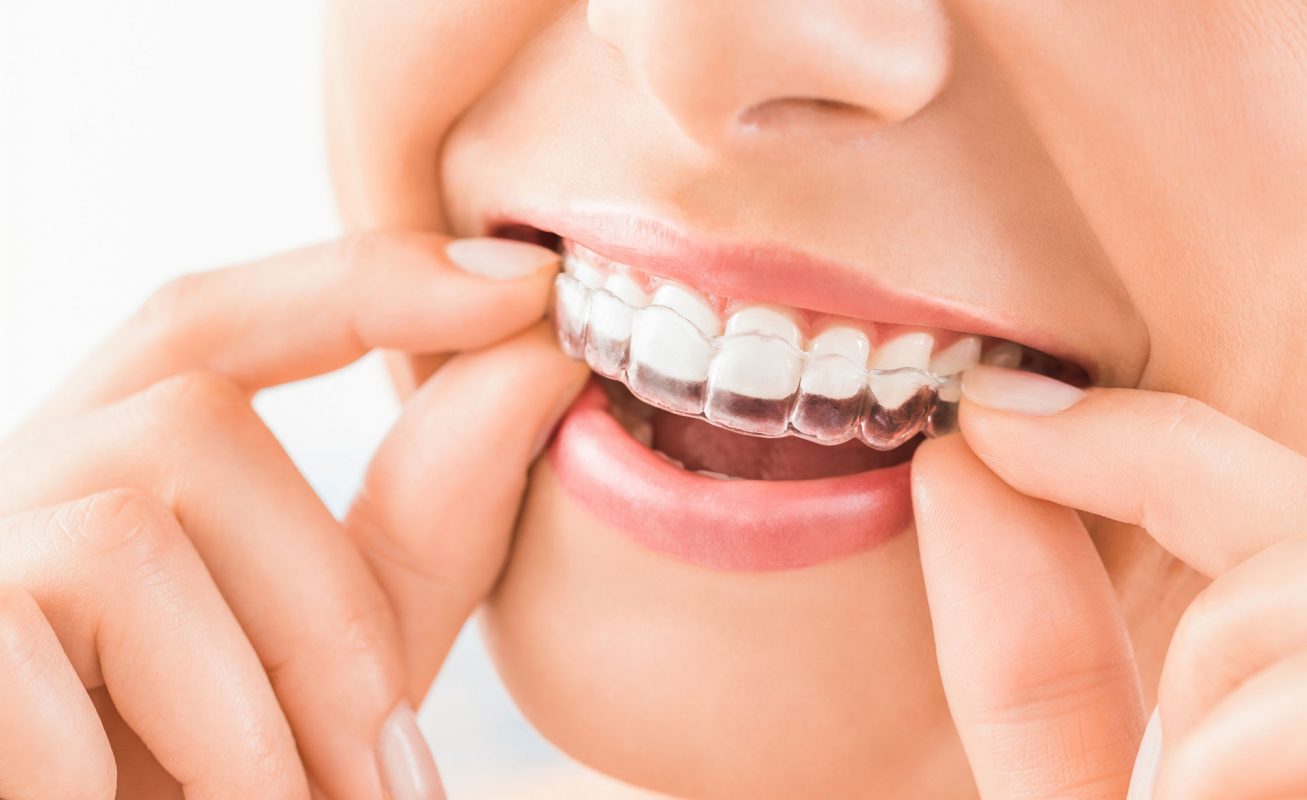 تقويم الاسنان, ابتسامة المشاهير, هووليود سمايل, تبييض الاسنان, تنظيف الاسنان, علاج الاسنان, افضل اخصائي تقويم الاسنان في ابوظبي, اجمل ابتسامة في ابوظبي