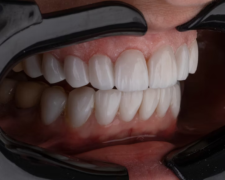تقويم الاسنان, ابتسامة المشاهير, هووليود سمايل, تبييض الاسنان, تنظيف الاسنان, علاج الاسنان, افضل اخصائي تقويم الاسنان في ابوظبي, اجمل ابتسامة في ابوظبي